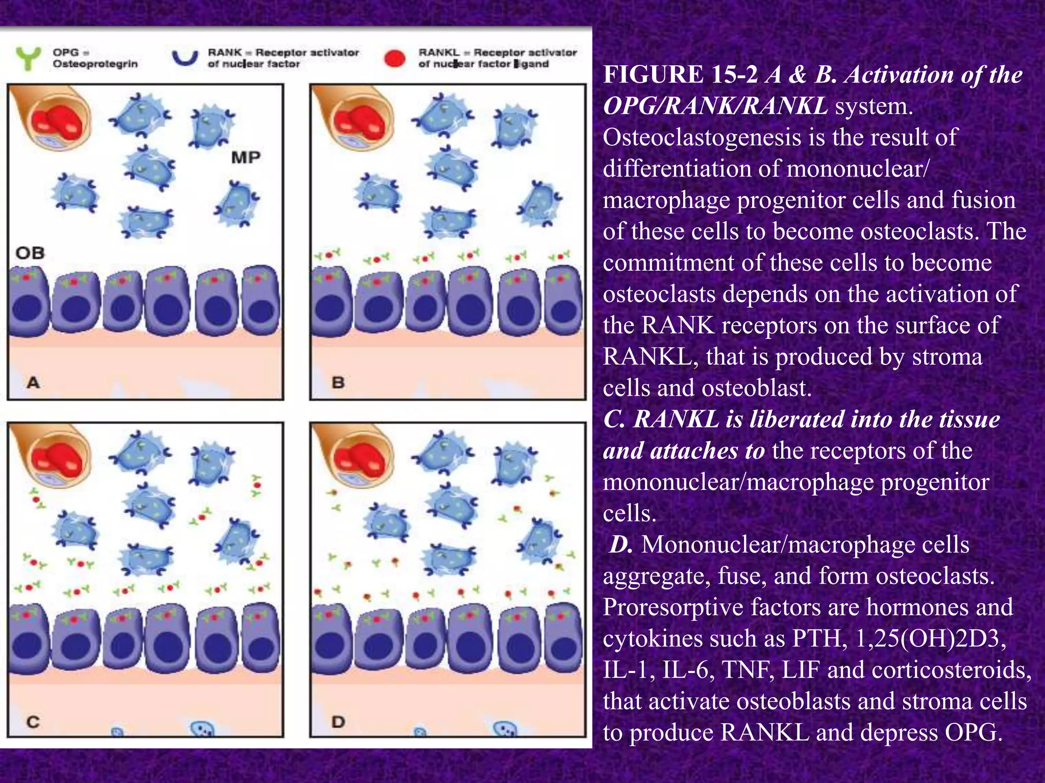 FIGURE 15-2 A & B. Activation of the
OPG/RANK/RANKL system.
Osteoclastogenesis is the result of
differentiation of mononuclear/
macrophage progenitor cells and fusion
of these cells to become osteoclasts. The
commitment of these cells to become
osteoclasts depends on the activation of
the RANK receptors on the surface of
RANKL, that is produced by stroma
cells and osteoblast.
C. RANKL is liberated into the tissue
and attaches to the receptors of the
mononuclear/macrophage progenitor
cells.
D. Mononuclear/macrophage cells
aggregate, fuse, and form osteoclasts.
Proresorptive factors are hormones and
cytokines such as PTH, 1,25(OH)2D3,
IL-1, IL-6, TNF, LIF and corticosteroids,
that activate osteoblasts and stroma cells
to produce RANKL and depress OPG.
 