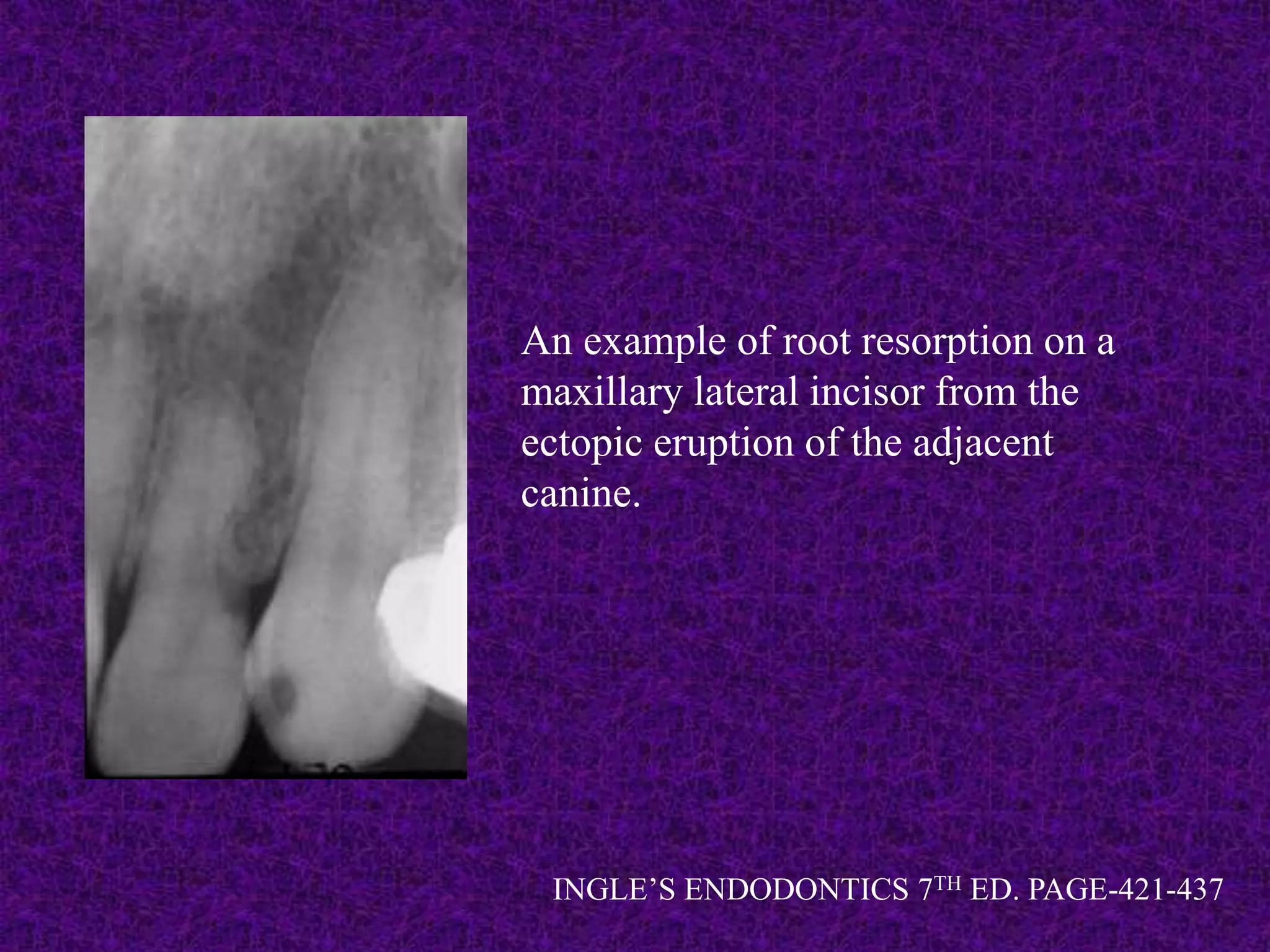 An example of root resorption on a
maxillary lateral incisor from the
ectopic eruption of the adjacent
canine.
INGLE’S ENDODONTICS 7TH ED. PAGE-421-437
 