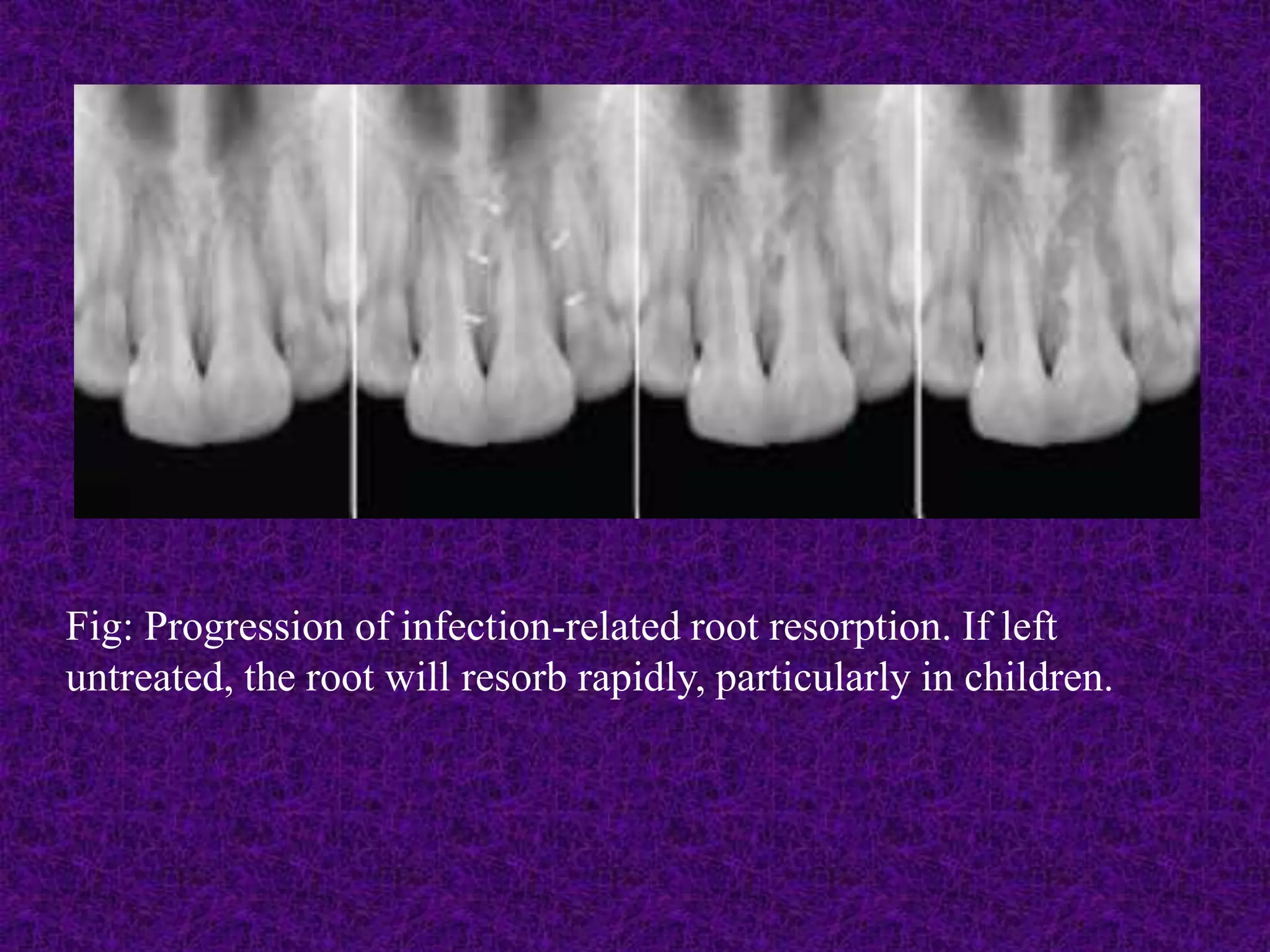 Fig: Progression of infection-related root resorption. If left
untreated, the root will resorb rapidly, particularly in children.
 