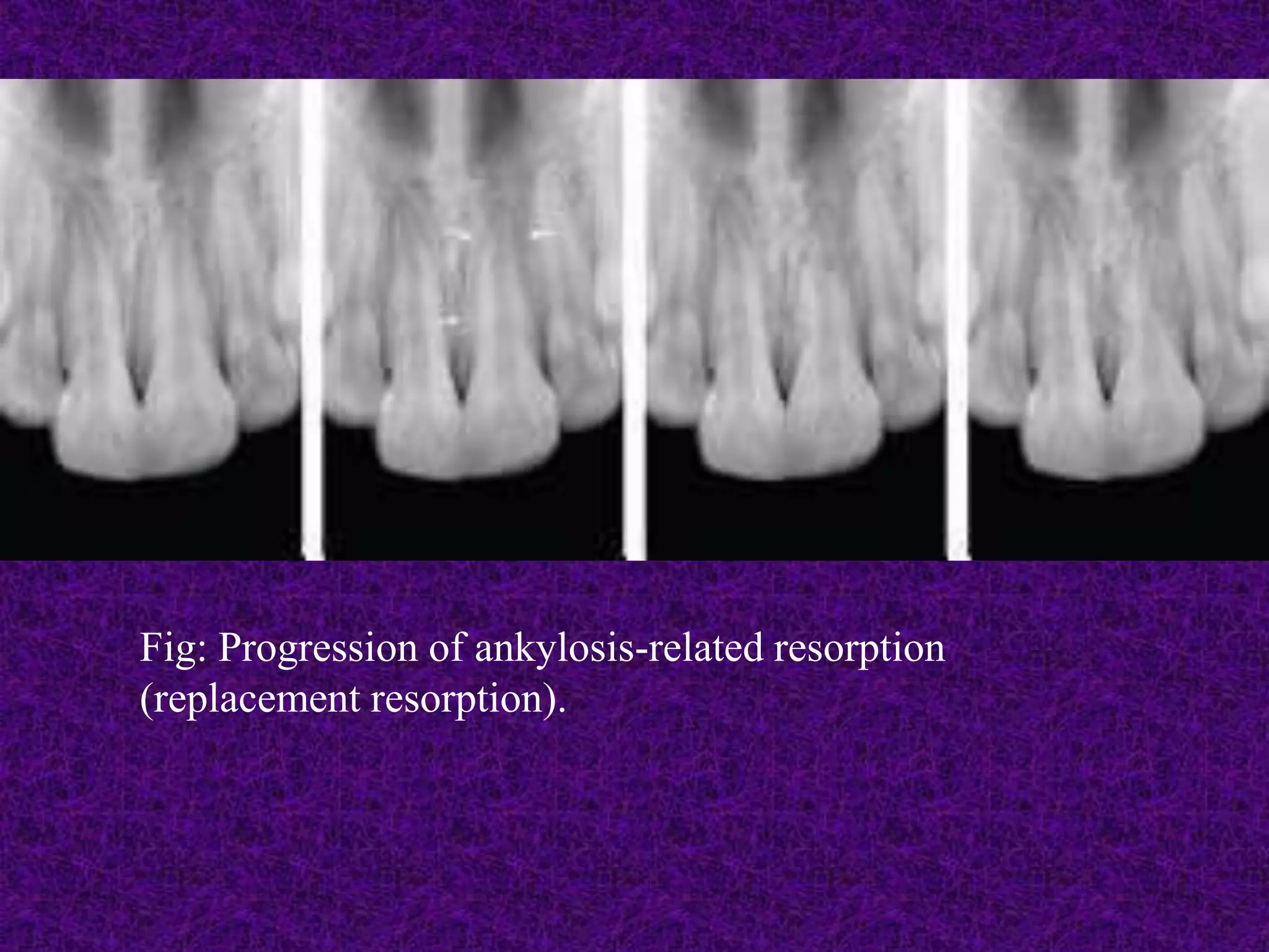 Fig: Progression of ankylosis-related resorption
(replacement resorption).
 