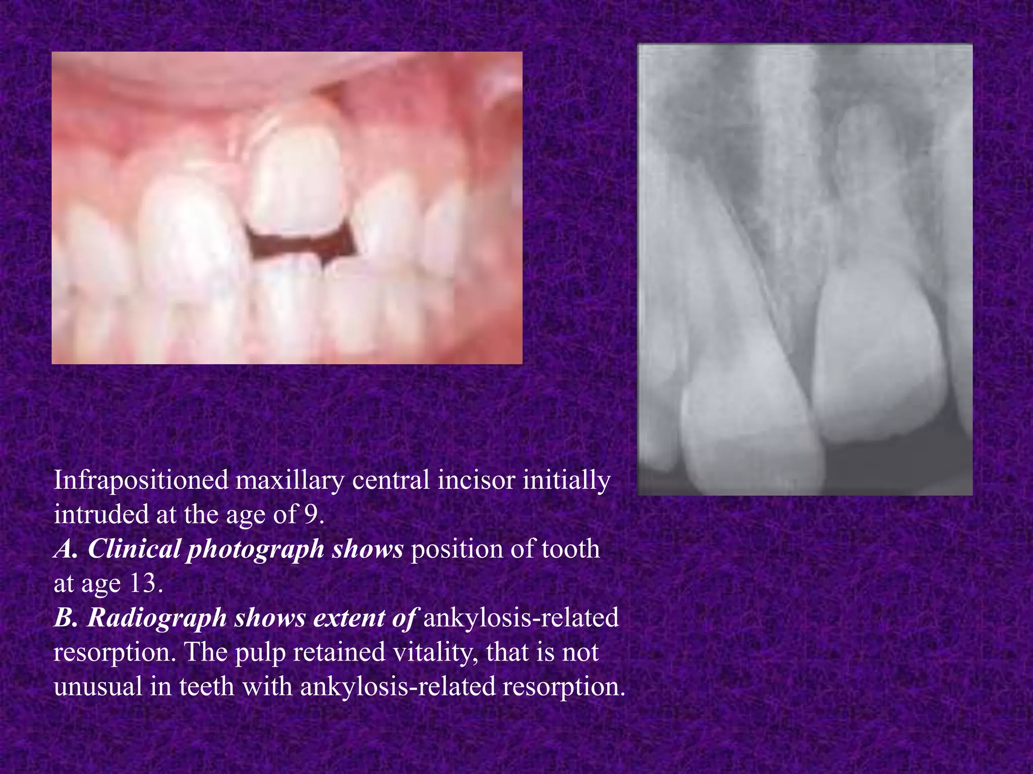 Infrapositioned maxillary central incisor initially
intruded at the age of 9.
A. Clinical photograph shows position of tooth
at age 13.
B. Radiograph shows extent of ankylosis-related
resorption. The pulp retained vitality, that is not
unusual in teeth with ankylosis-related resorption.
 