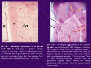 FIGURE : Histologic appearance of an incisor
tooth with the first stage of invasive cervical
resorption. An intact layer of predentin and dentin
(*) separates the pulp (p) from the mass of fibro-
vascular resorptive tissue (fvt) that contain both
mononucleated and multinucleated clastic cells.
FIGURE : Histological appearance of an extensive
invasive cervical resorption with radicular extensions.
The resorptive tissue within the resorption cavity is
fibro-osseous in character (red arrows) and there are
bone like deposits at an interface with resorbed dentin,
akin to replacement resorption (yellow arrows). There
are also inter-communicating channels with the
periodontal ligament (black arrows) and deeply
penetrating small channels within the residual dentin
(blue arrows).
 