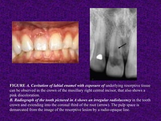 FIGURE A. Cavitation of labial enamel with exposure of underlying resorptive tissue
can be observed in the crown of the maxillary right central incisor, that also shows a
pink discoloration.
B. Radiograph of the tooth pictured in A shows an irregular radiolucency in the tooth
crown and extending into the coronal third of the root (arrow). The pulp space is
demarcated from the image of the resorptive lesion by a radio-opaque line.
 