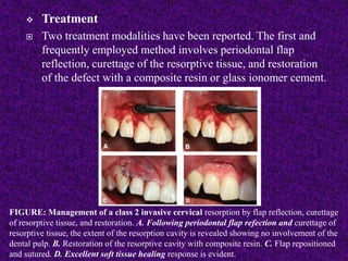  Treatment
 Two treatment modalities have been reported. The first and
frequently employed method involves periodontal flap
reflection, curettage of the resorptive tissue, and restoration
of the defect with a composite resin or glass ionomer cement.
FIGURE: Management of a class 2 invasive cervical resorption by flap reflection, curettage
of resorptive tissue, and restoration. A. Following periodontal flap refection and curettage of
resorptive tissue, the extent of the resorption cavity is revealed showing no involvement of the
dental pulp. B. Restoration of the resorptive cavity with composite resin. C. Flap repositioned
and sutured. D. Excellent soft tissue healing response is evident.
 