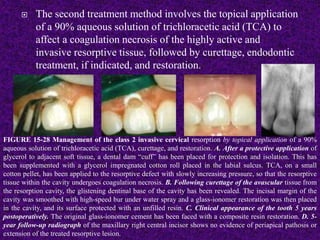  The second treatment method involves the topical application
of a 90% aqueous solution of trichloracetic acid (TCA) to
affect a coagulation necrosis of the highly active and
invasive resorptive tissue, followed by curettage, endodontic
treatment, if indicated, and restoration.
FIGURE 15-28 Management of the class 2 invasive cervical resorption by topical application of a 90%
aqueous solution of trichloracetic acid (TCA), curettage, and restoration. A. After a protective application of
glycerol to adjacent soft tissue, a dental dam “cuff” has been placed for protection and isolation. This has
been supplemented with a glycerol impregnated cotton roll placed in the labial sulcus. TCA, on a small
cotton pellet, has been applied to the resorptive defect with slowly increasing pressure, so that the resorptive
tissue within the cavity undergoes coagulation necrosis. B. Following curettage of the avascular tissue from
the resorption cavity, the glistening dentinal base of the cavity has been revealed. The incisal margin of the
cavity was smoothed with high-speed bur under water spray and a glass-ionomer restoration was then placed
in the cavity, and its surface protected with an unfilled resin. C. Clinical appearance of the tooth 5 years
postoperatively. The original glass-ionomer cement has been faced with a composite resin restoration. D. 5-
year follow-up radiograph of the maxillary right central incisor shows no evidence of periapical pathosis or
extension of the treated resorptive lesion.
 