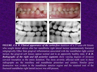 FIGURE A & B. Clinical appearance of the caries-free dentition of a 27-year-old female
who sought dental advice after her mandibular right lateral incisor spontaneously fractured
subgingivally Other than gingival inflammation associated with the mandibular right central
incisor, the gingival soft tissues appear normal and in an apparently healthy state. C & D.
Radiographs of the right and left posterior segments show varying degrees of invasive
cervical resorption in the entire dentition. The most severely affected teeth seen in these
radiographs are the maxillary and mandibular premolars and canines. Similar gross
destruction was evident in the mandibular anterior region and the retained root of the
fractured mandibular right lateral incisor was still present.
 