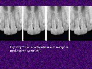 Fig: Progression of ankylosis-related resorption
(replacement resorption).
 