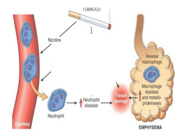 RESPIRATORY SYSTEM: EMPHYSEMA, CHRONIC BRONCHITIS