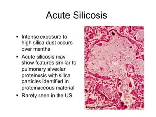Acute Silicosis
 Intense exposure to
high silica dust occurs
over months
 Acute silicosis may
show features similar to
pulmonary alveolar
proteinosis with silica
particles identified in
proteinaceous material
 Rarely seen in the US
 