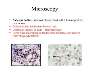 Microscopy
 Asbestos bodies: asbestos fibres coated with a film of proteins
rich in iron.
 Golden brown, fusiform or beaded rods.
 coating is thickest at ends - Dumbell shape
 form when macrophages phagocytose asbestos, iron derived
from phagocyte ferritin.
 