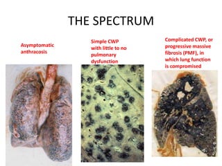 THE SPECTRUM
Asymptomatic
anthracosis
Simple CWP
with little to no
pulmonary
dysfunction
Complicated CWP, or
progressive massive
fibrosis (PMF), in
which lung function
is compromised
 