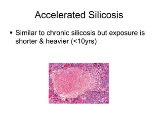 Accelerated Silicosis
 Similar to chronic silicosis but exposure is
shorter & heavier (<10yrs)
 