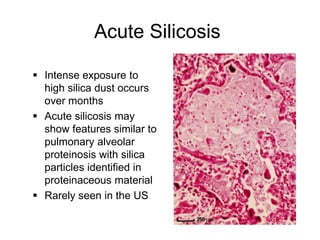 Acute Silicosis
 Intense exposure to
high silica dust occurs
over months
 Acute silicosis may
show features similar to
pulmonary alveolar
proteinosis with silica
particles identified in
proteinaceous material
 Rarely seen in the US
 