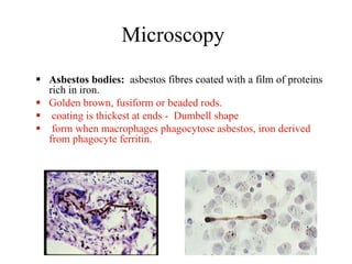 Microscopy
 Asbestos bodies: asbestos fibres coated with a film of proteins
rich in iron.
 Golden brown, fusiform or beaded rods.
 coating is thickest at ends - Dumbell shape
 form when macrophages phagocytose asbestos, iron derived
from phagocyte ferritin.
 