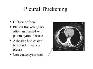 Pleural Thickening
 Diffuse or focal
 Pleural thickening are
often associated with
parenchymal disease
 Asbestos bodies can
be found in visceral
pleura
 Can cause symptoms
 