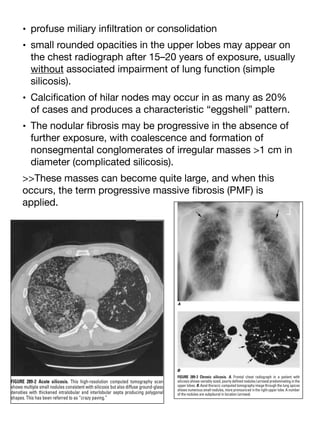 • profuse miliary in
fi
ltration or consolidation
• small rounded opacities in the upper lobes may appear on
the chest radiograph after 15–20 years of exposure, usually
without associated impairment of lung function (simple
silicosis).
• Calci
fi
cation of hilar nodes may occur in as many as 20%
of cases and produces a characteristic “eggshell” pattern.
• The nodular
fi
brosis may be progressive in the absence of
further exposure, with coalescence and formation of
nonsegmental conglomerates of irregular masses >1 cm in
diameter (complicated silicosis).
>>These masses can become quite large, and when this
occurs, the term progressive massive
fi
brosis (PMF) is
applied.
 