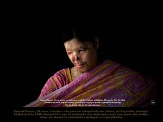 Kanwal Kayurn, 26 anos, compõe o véu para ser fotografada em Lahore, no Paquistão, domingo  26 Outubro de 2008. Kanwal há 1 ano foi queimada com ácido pelo rapaz com quem não aceitou  casar-se. Nunca foi submetida a qualquer cirurgia plástica. 
