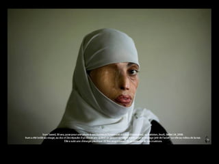 Irum Saeed, 30 anos, deixa-se fotografar no seu escritório, na Universidade de Islamabad, no Paquistão, 5ªfeira, 24 de Julho 2008. Há 12 anos Irum foi queimada no rosto, costas e ombros, no meio da rua, por um rapaz com quem se tinha recusado casar. Irum foi submetida a 25 cirurgias plásticas para tentar remover as cicatrizes. 