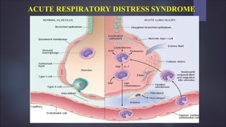 ACUTE RESPIRATORY DISTRESS SYNDROME
 