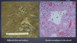 Diffusely firm and rubbery Hyaline membrane in the alveoli
 