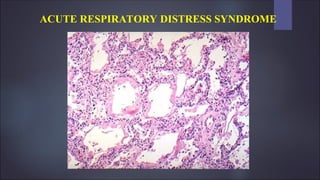 fig
ACUTE RESPIRATORY DISTRESS SYNDROME
 