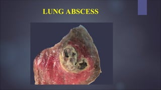 LUNG ABSCESS
 