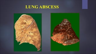 LUNG ABSCESS
 