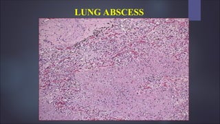 LUNG ABSCESS
 