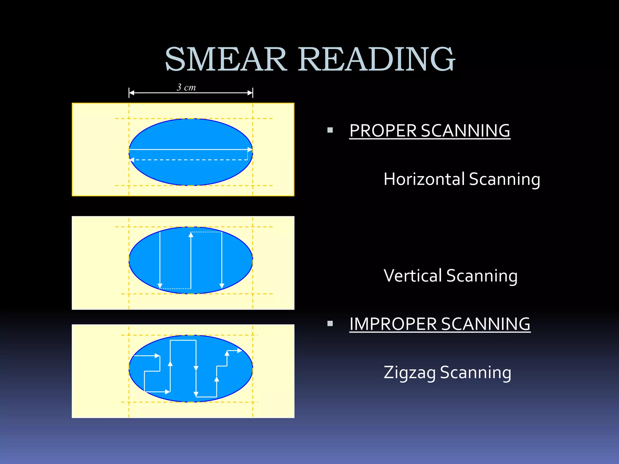 Ideal sputum specimen?MICROSCOPICgreater than 25 wbc/LPO, 5 wbc/OIO