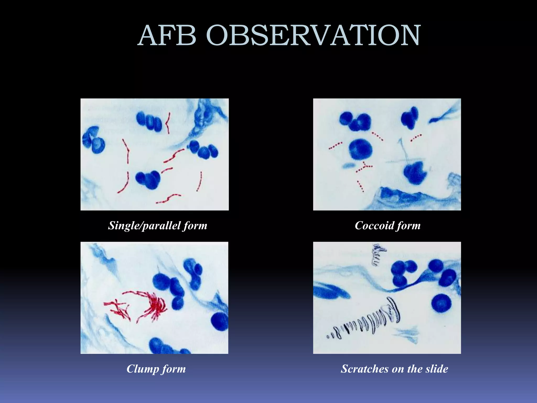 Presence of alveolar macrophage, dust cellsAFB STAINING