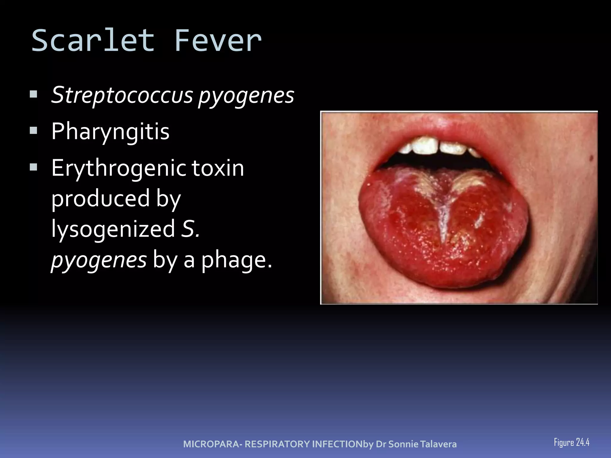 Scarlet FeverStreptococcus pyogenesPharyngitisErythrogenic toxin produced by lysogenizedS. pyogenesby a phage.Figure 24.4MICROPARA- RESPIRATORY INFECTIONby Dr Sonnie Talavera