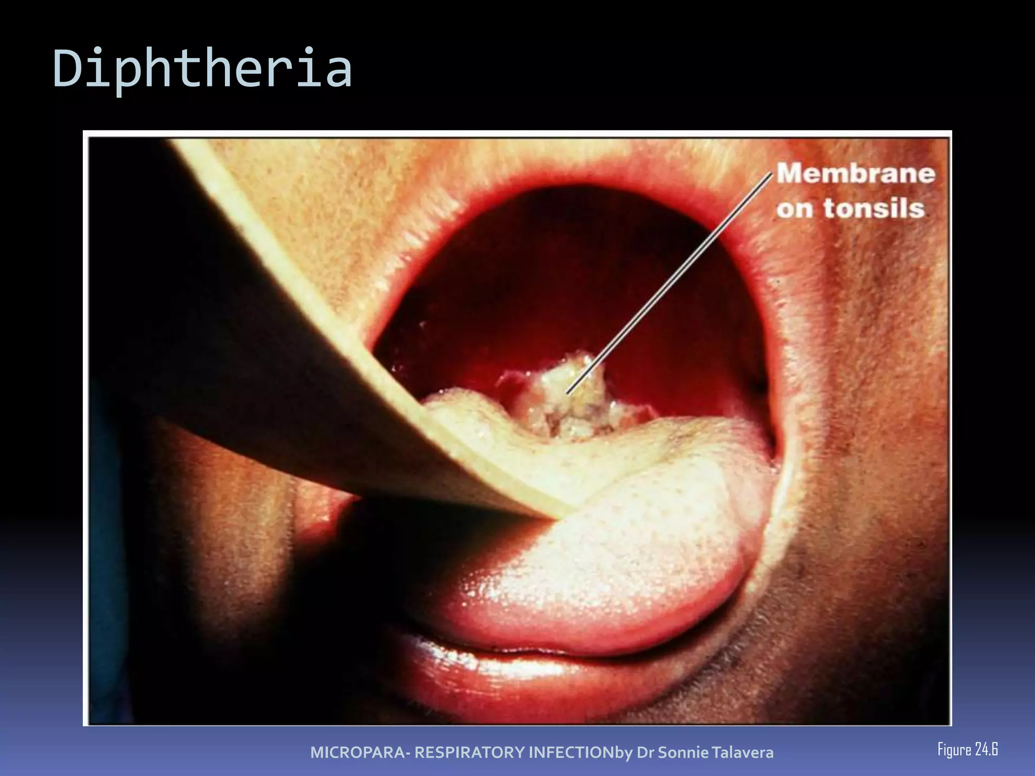 DiphtheriaFigure 24.6MICROPARA- RESPIRATORY INFECTIONby Dr Sonnie Talavera