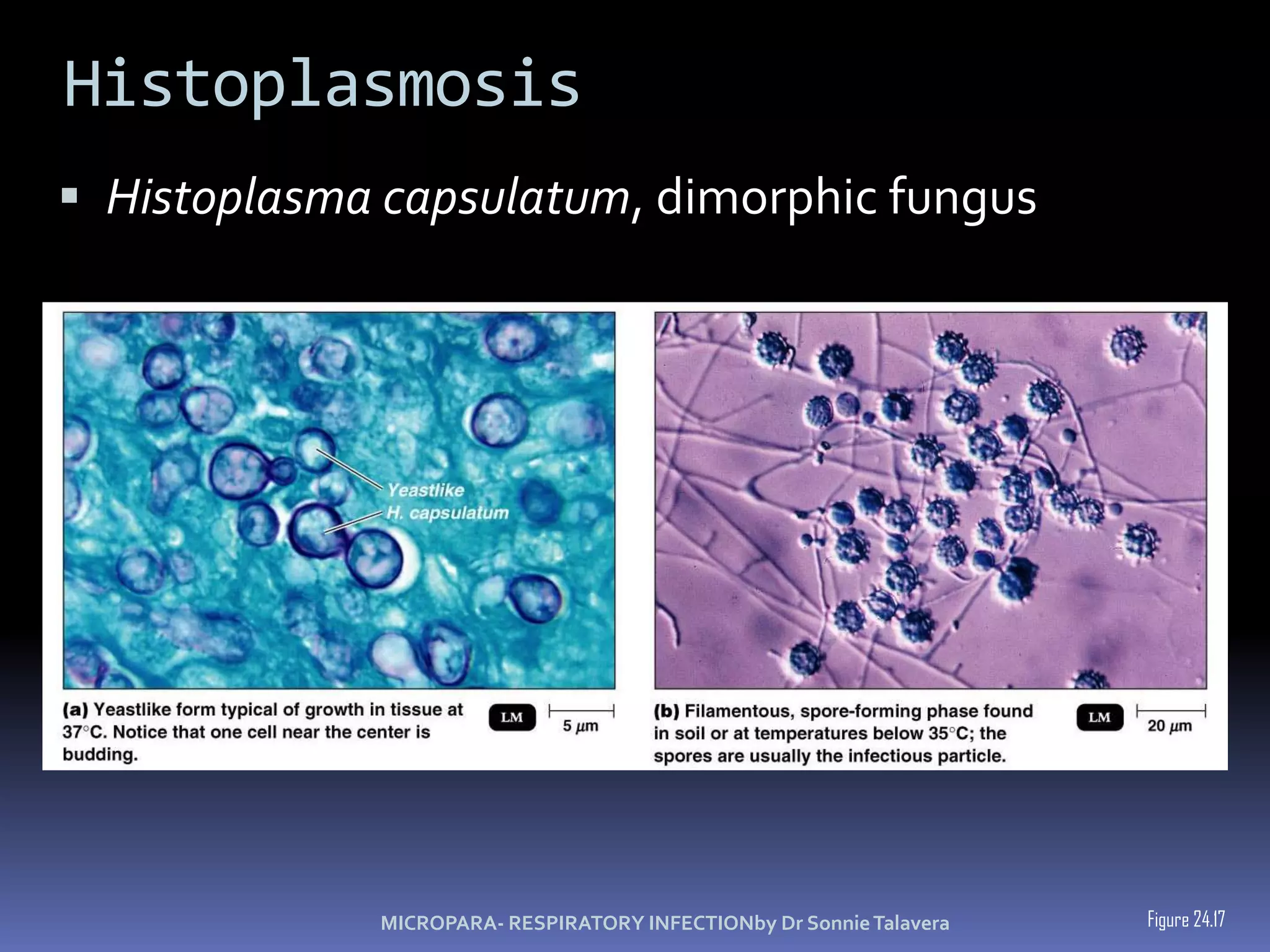 MICROPARA- RESPIRATORY INFECTIONby Dr Sonnie Talavera
