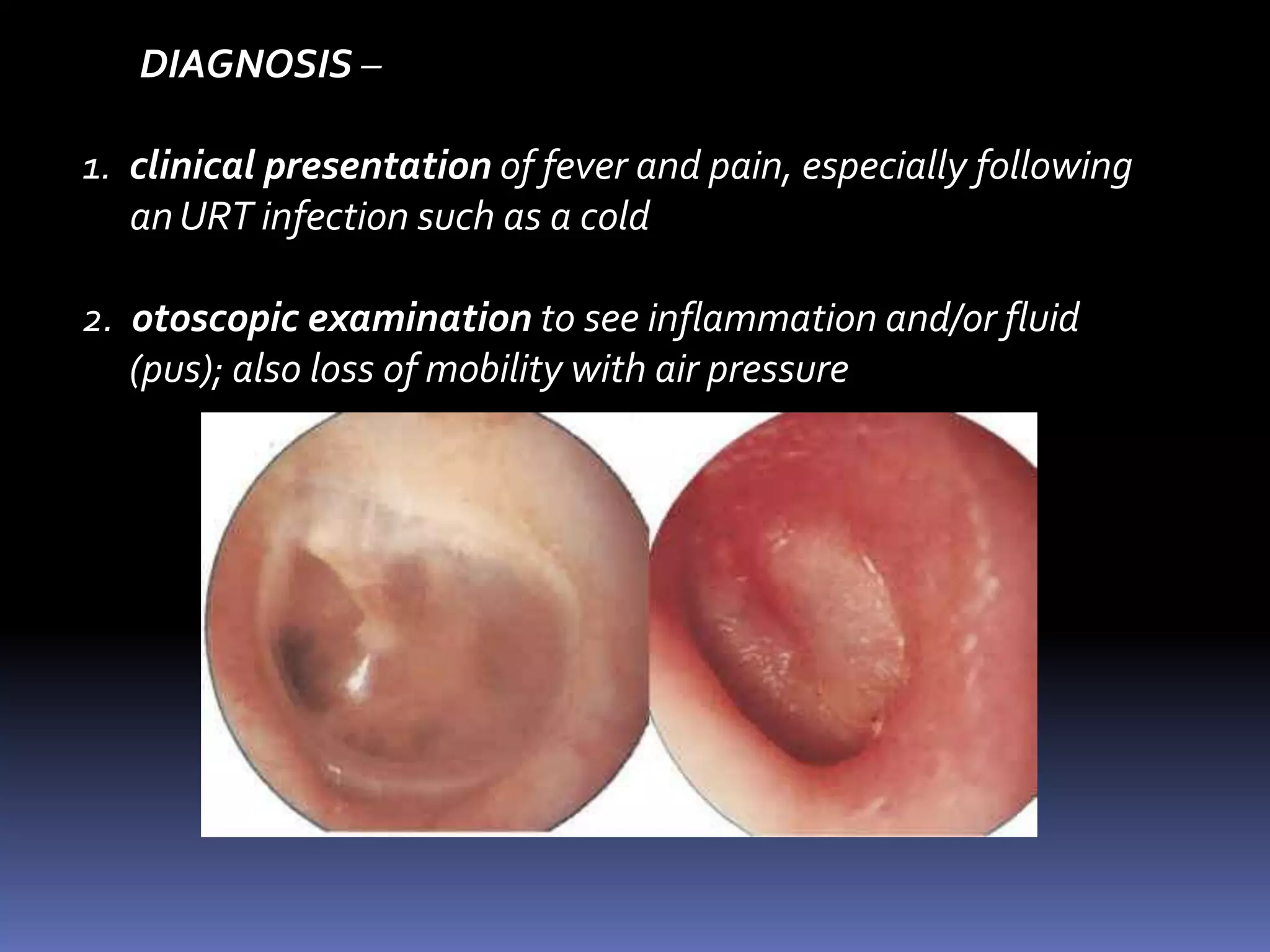 otitis media with effusionA.  Symptoms - fever, pain in the ear, dulled hearing. 