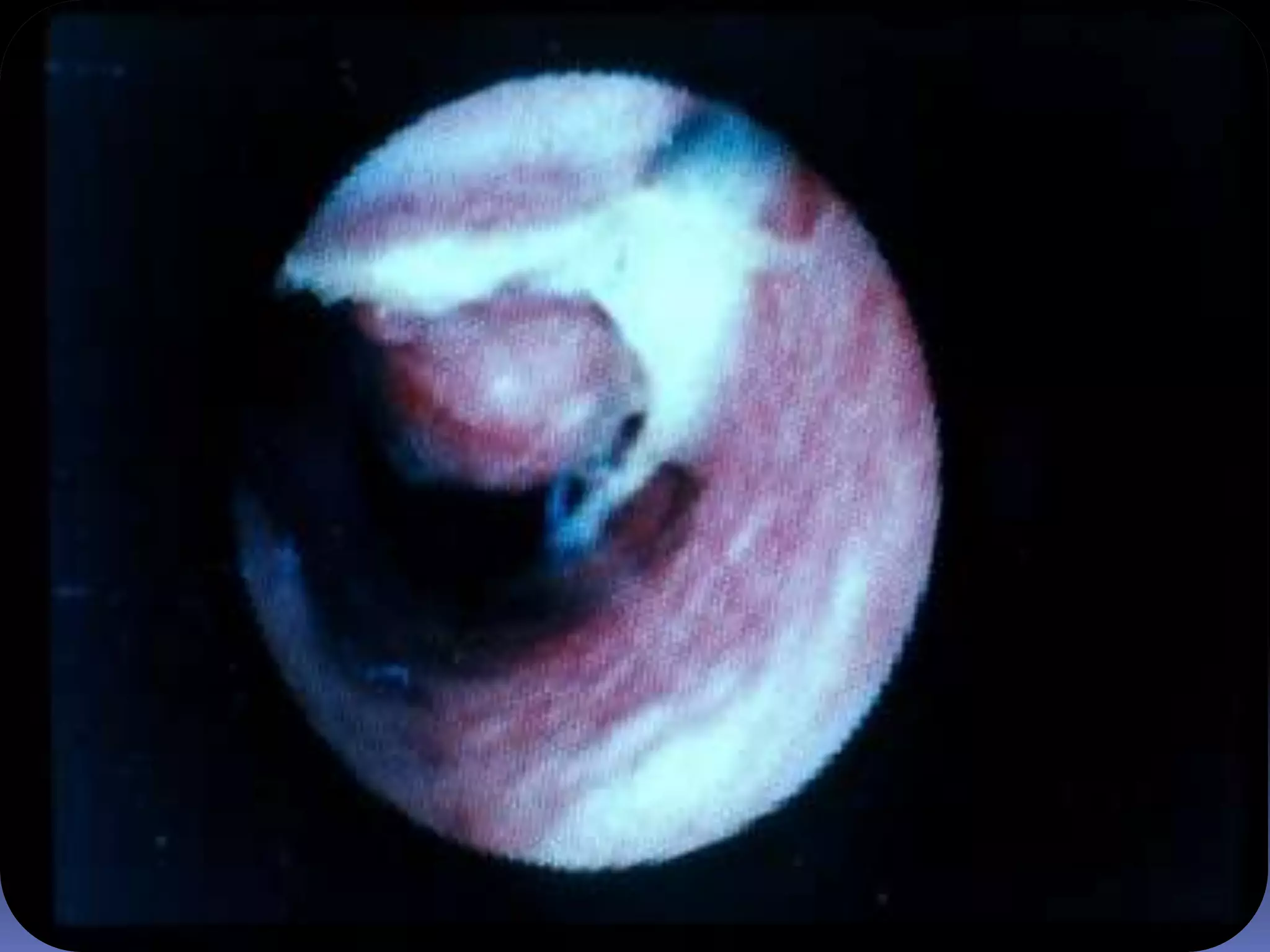 Otitis MediaS. pneumoniae (35%)H. influenzae (20-30%)M. catarrhalis (10-15%)S. pyogenes (8-10%)S. aureus (1-2%)RSVAffects 85% of children before  age 3, and estimated 8 million cases/ yearFigure 24.7MICROPARA- RESPIRATORY INFECTIONby Dr Sonnie Talavera