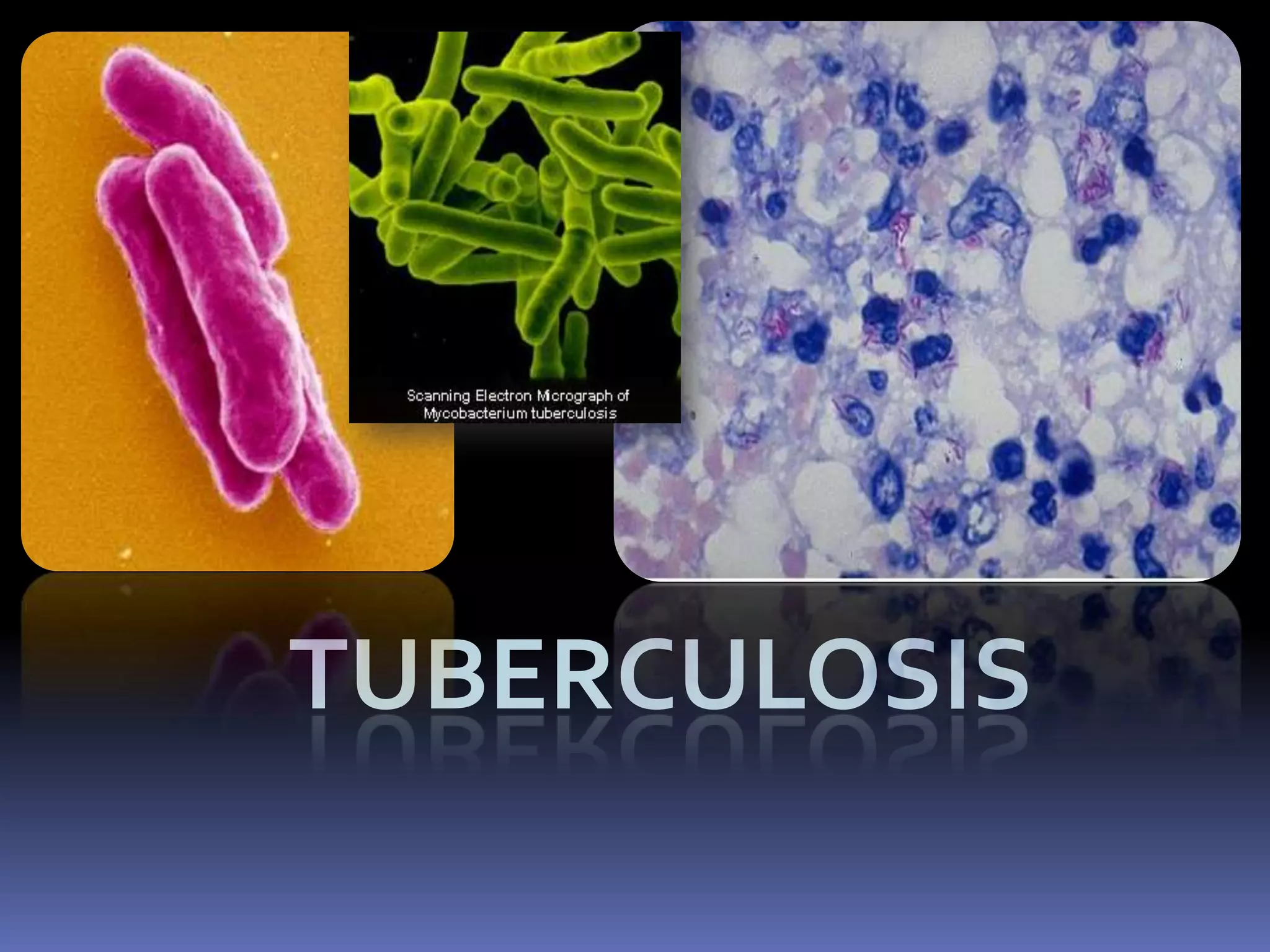 Whooping coughSymptomsSevere coughing, spasms, inspiratory whoop LymphocytosisStages of diseaseCatarrhal -> Paroxysmal -> ConvalescentSpread--highlycontagiousInhalation or direct contact with secretionUsually self-limitingNeurological sequelaeSecondary respiratory infectionsSecondary aspiration pneumoniaeleading cause of death