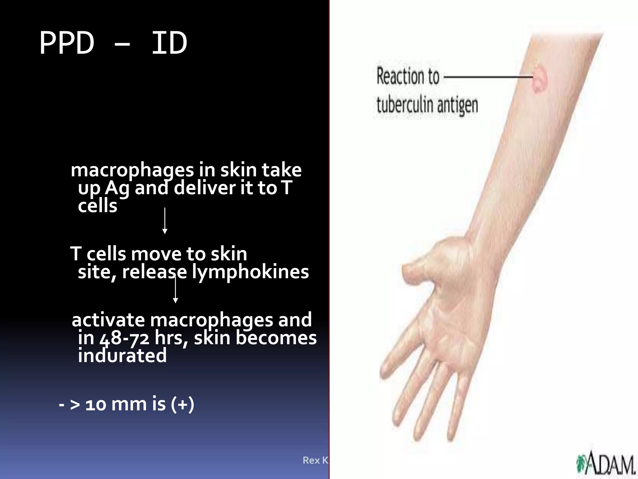 Rex Karl S. Teoxon, R.N, M.D46PTBMycobacterium tubercle, acid fast bacilliAirborne/dropletsPott’s disease – thoracolumbarMilliary TB – kidney, liver, lungs