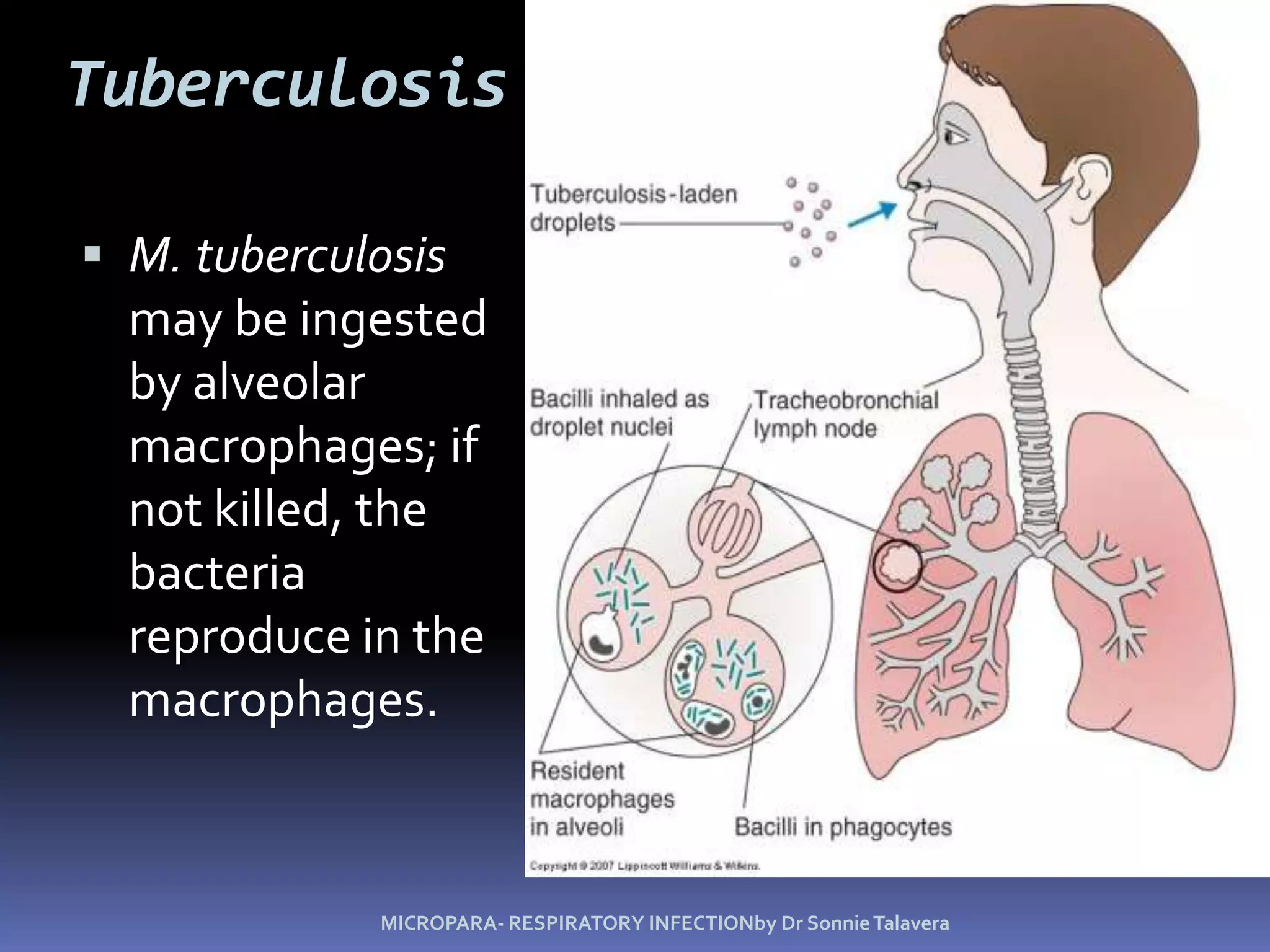 TB symptomsCough with two weeks or moreSputum expectorationFeverSignificant weight lossHemoptysisChest and/or back pains