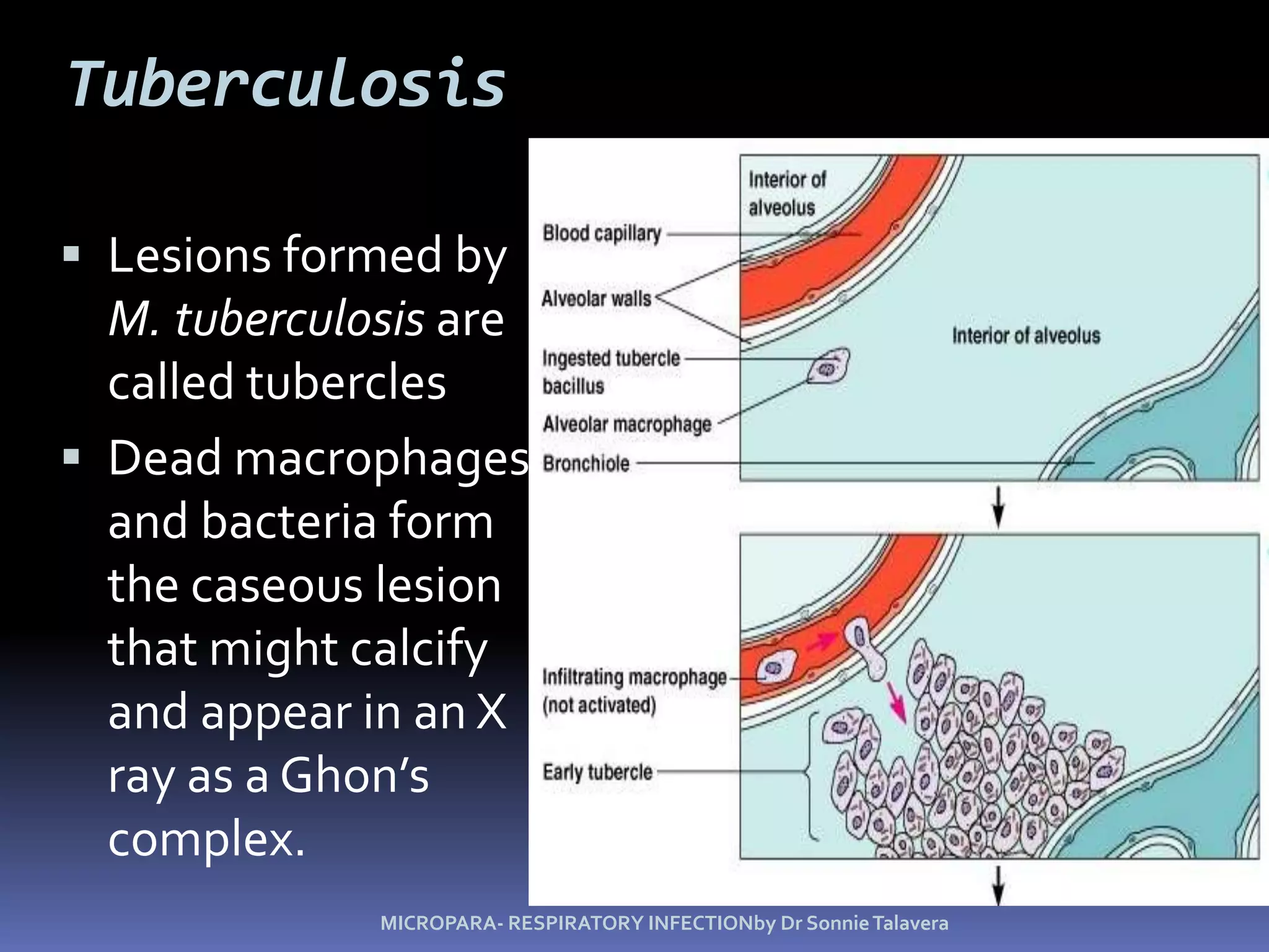 Rex Karl S. Teoxon, R.N, M.D52SIGNS AND SYMPTOMSWt loss, night sweats, low fever, non productive to productive cough, anorexia, Pleural effusion and hypoxemia, cervical lymphadenopathy