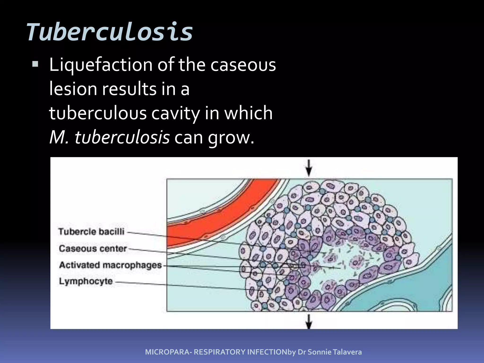 TuberculosisMycobacterium tuberculosis: Acid-fast rod; transmitted from human to human.M. bovis: <1% U.S. cases, not transmitted from human to human.M. avium-intracellulare complex infects people with late stage HIV infection.Figure 24.9MICROPARA- RESPIRATORY INFECTIONby Dr Sonnie Talavera