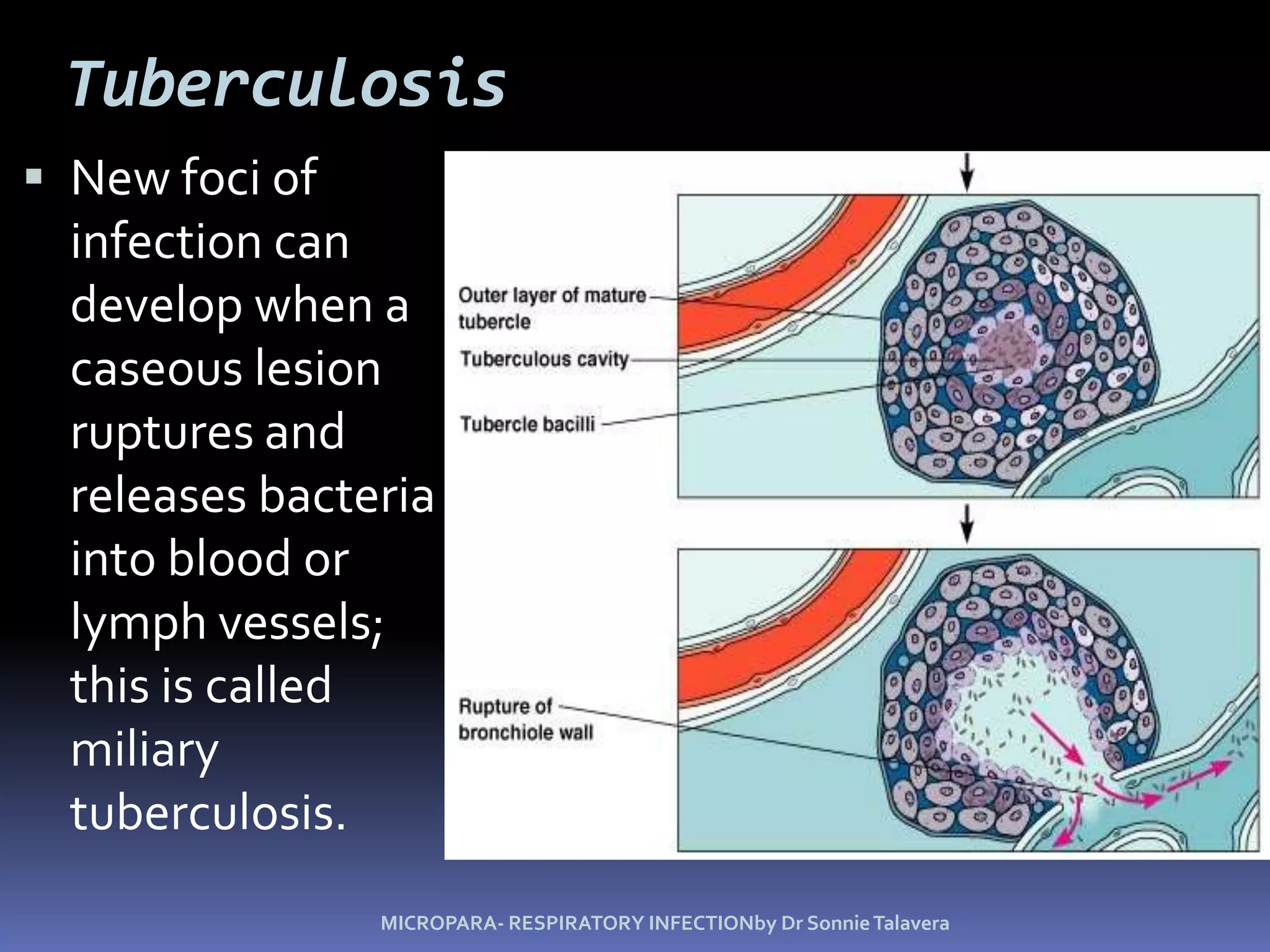 TuberculosisMycobacterium tuberculosisAcid fast-lipid, waxSlow growth (nutrient permeability)Resist to detergent and common antibioticsA leading cause of death by infectious disease 50% population infected, 3m death/yrReemergence in 1980 (AIDS, homeless, immigrants)DiagnosePPD testChest X-raySputum smear (for acid-fast bacilli)Sputum culture