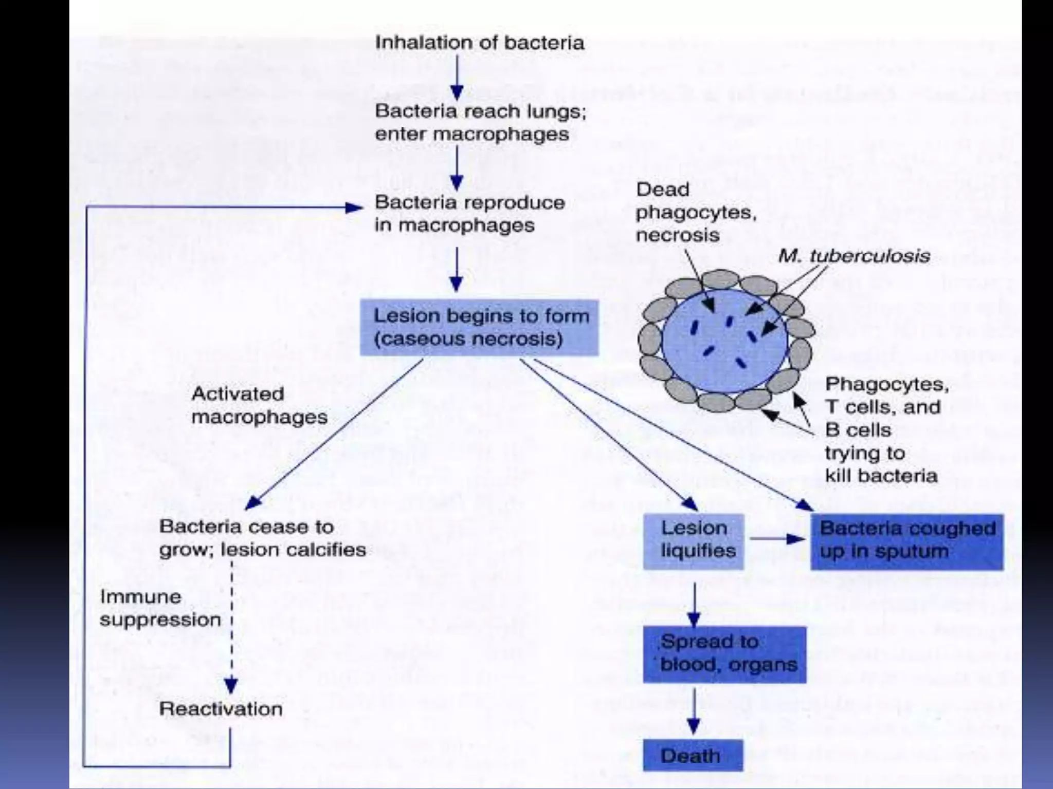 DiagnosisSputum culture