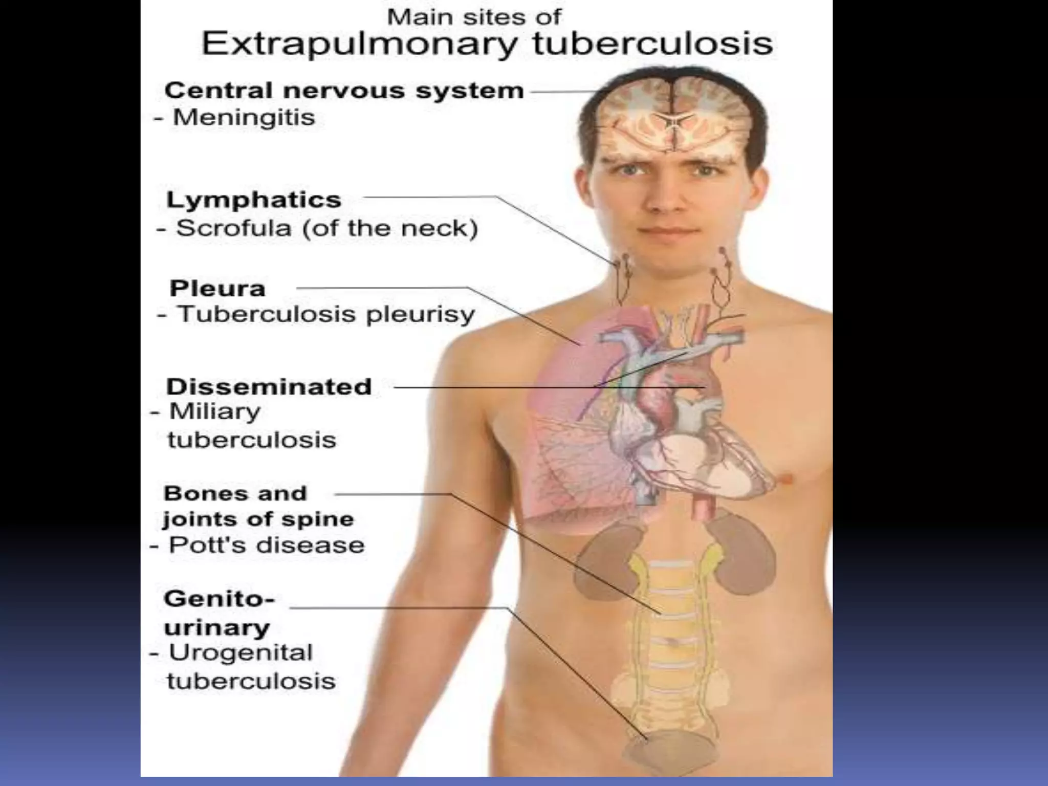 Rex Karl S. Teoxon, R.N, M.D57DIAGNOSISChest x ray - cavitary lesion Sputum exam Sputum culture