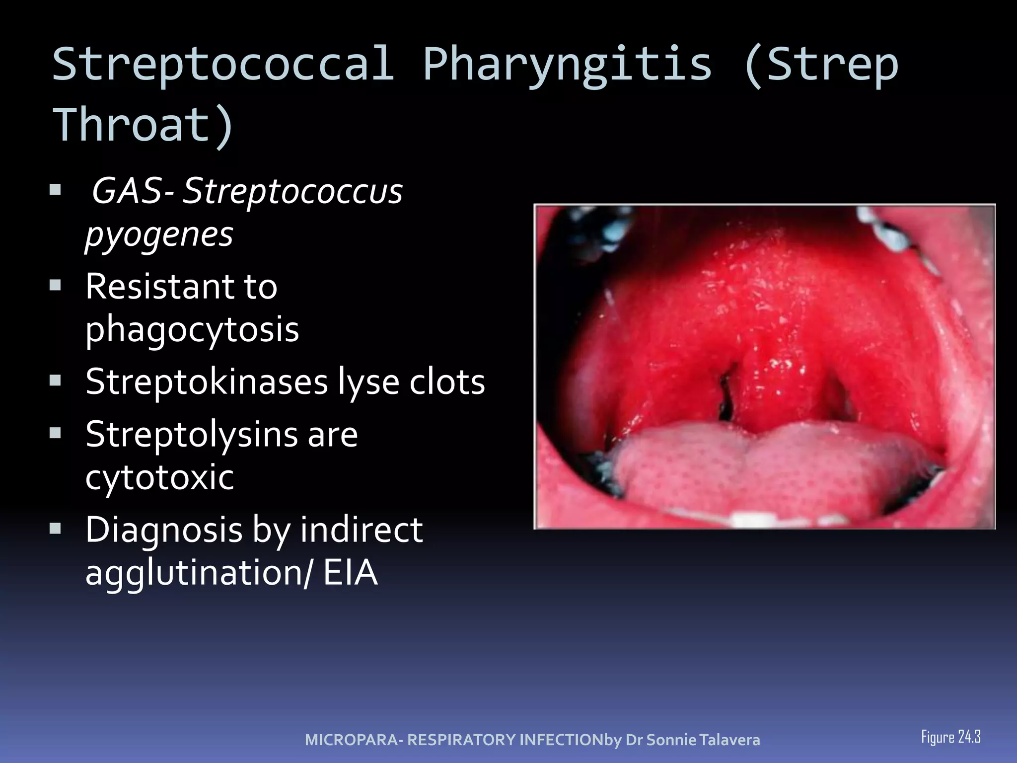 Streptococcal Pharyngitis (Strep Throat) GAS- Streptococcus pyogenesResistant to phagocytosisStreptokinaseslyse clotsStreptolysins are cytotoxicDiagnosis by indirect agglutination/ EIAFigure 24.3MICROPARA- RESPIRATORY INFECTIONby Dr Sonnie Talavera