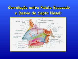 Correlação entre Palato EscavadoCorrelação entre Palato Escavado
e Desvio de Septo Nasal:e Desvio de Septo Nasal:
 