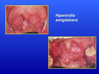Hipertrofia
amigdaliana
 
