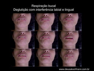 Respiração bucalDeglutição com interferência labial e lingual www.cleusakochhann.com.br 