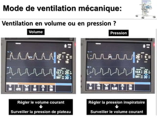 Mode de ventilation mécanique:
Ventilation en volume ou en pression ?
 
