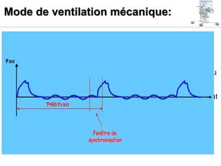 Mode de ventilation mécanique:
Ventilation assistée contrôlée intermittente: ( VACI )
• Méthode VAC dont la ventilation à fréquence lente permet la
VS, entre deux cycles.
• La machine synchronise ses cycles mécaniques avec la VS du
patient.
• Le patient prend le volume qu’il veut à la fréquence qu’il veut
, qui peut être assisté d’une aide inspiratoire et d’une Peep
 
