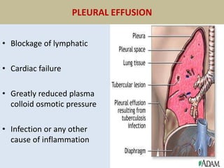 PLEURAL EFFUSION
• Blockage of lymphatic
• Cardiac failure
• Greatly reduced plasma
colloid osmotic pressure
• Infection or any other
cause of inflammation
 